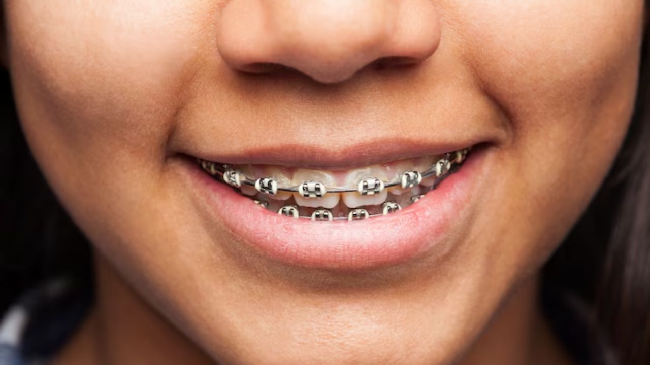 Dental Braces Kolkata