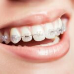 Invisalign Braces Cost in Kolkata