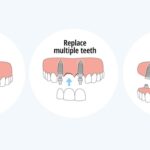 dental implants kolkata