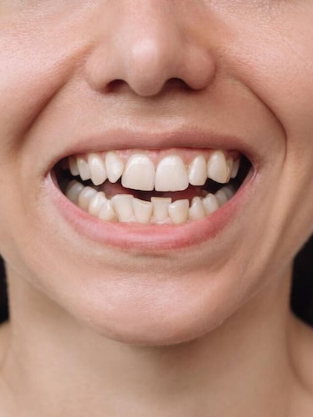 Adult with crooked teeth after taking off braces