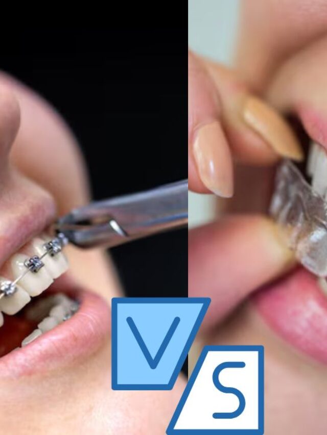 Clear aligners & traditional metal braces side by side